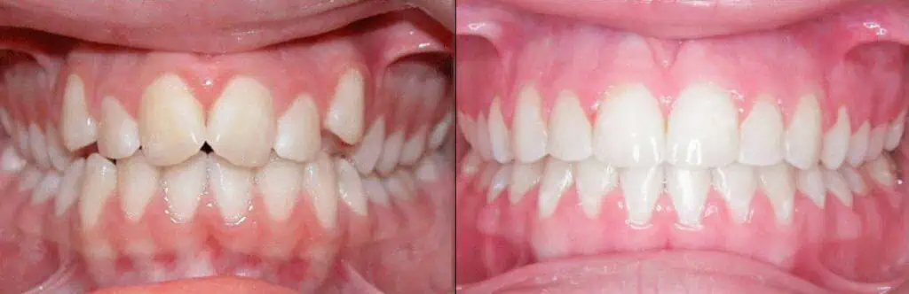 Orthodontic treatment consultation at Stang Family Orthodontics