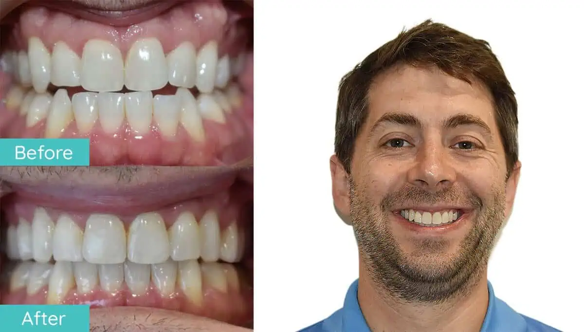 Northern Virginia braces before and after smile result