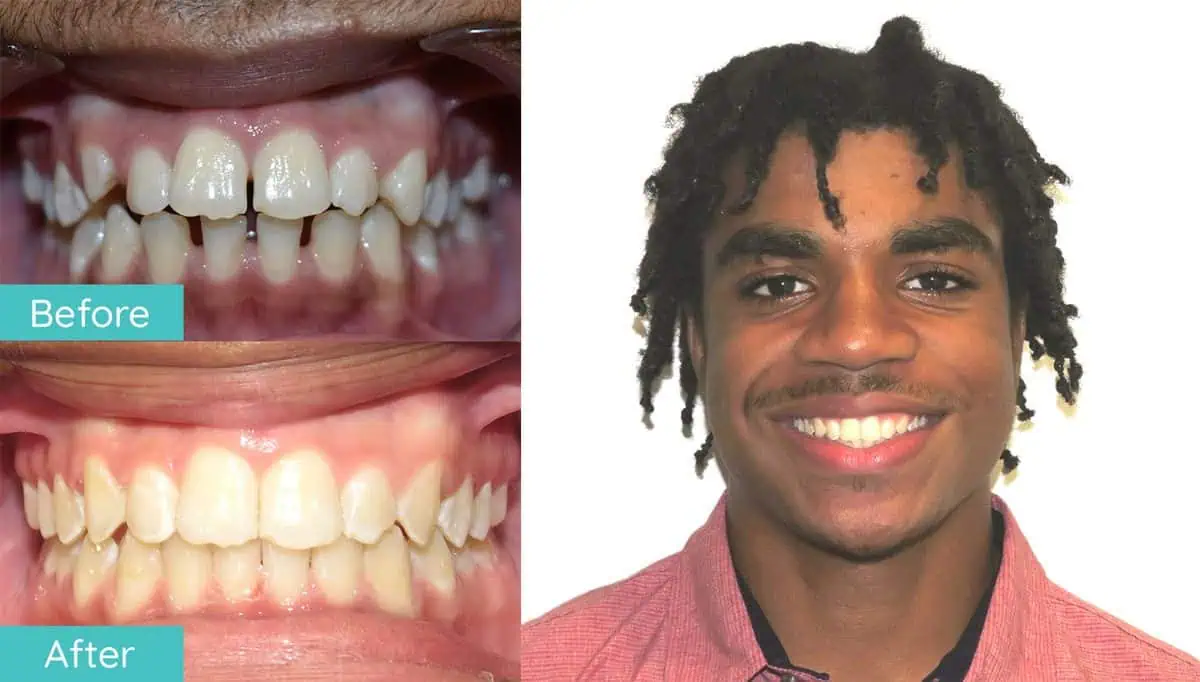 Northern Virginia braces before and after smile result