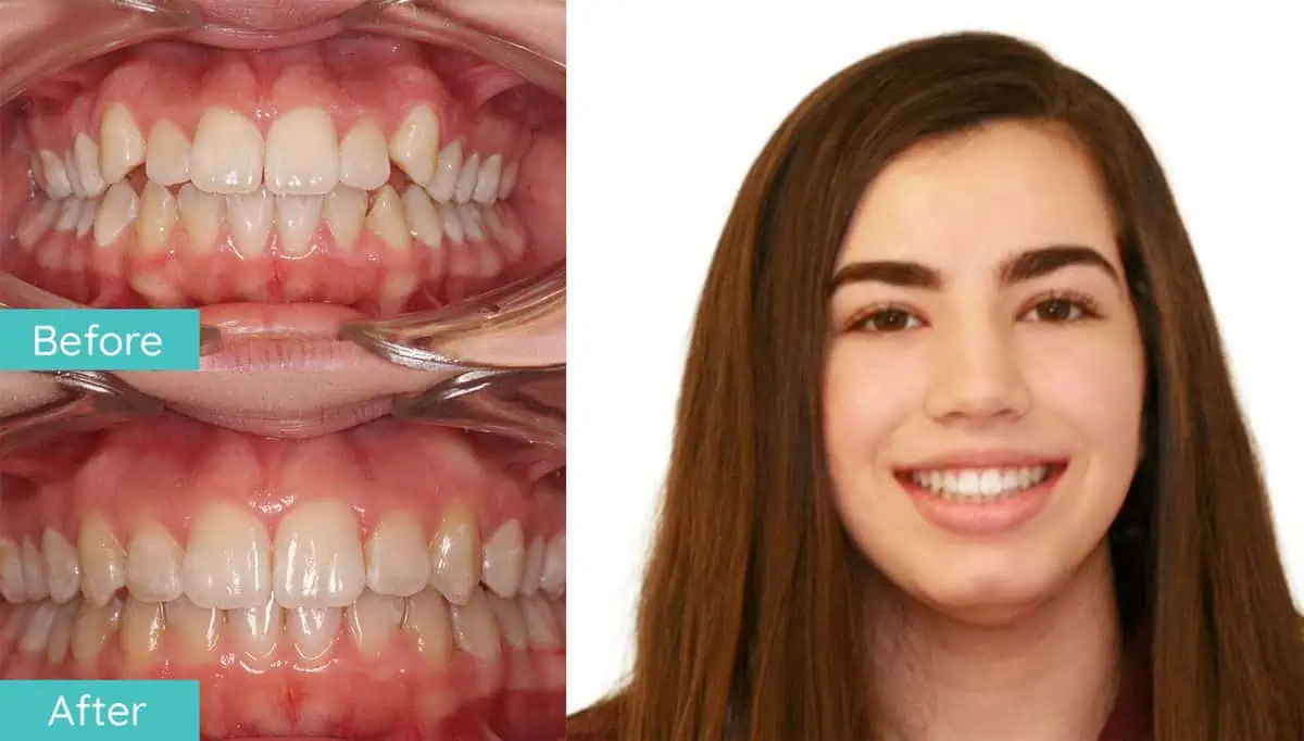 Northern Virginia braces before and after smile result