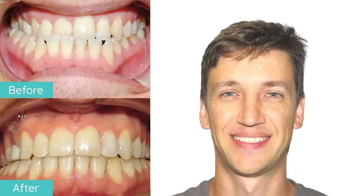 Northern Virginia braces before and after smile result