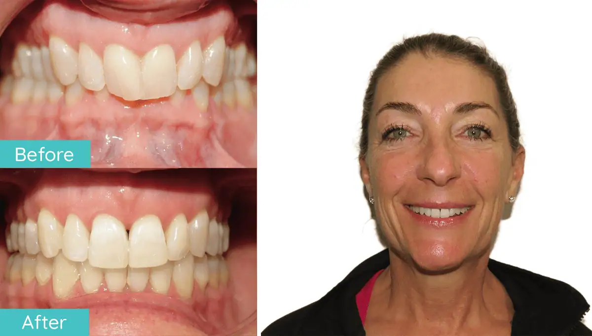 Northern Virginia braces before and after smile result