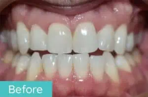 Patient's teeth before orthodontic treatment (case 1)