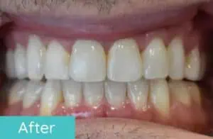 Patient's teeth after orthodontic treatment (case 1)