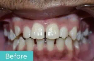 Patient's teeth before orthodontic treatment (case 2)