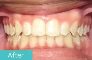 Patient's teeth after orthodontic treatment (case 2)