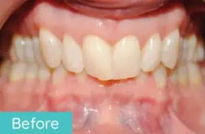 Patient's teeth before orthodontic treatment (case 3)