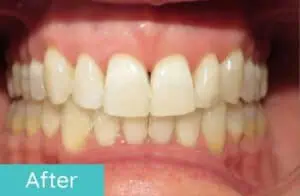 Patient's teeth after orthodontic treatment (case 3)