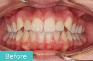 Patient's teeth before orthodontic treatment (case 4)
