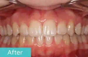 Patient's teeth after orthodontic treatment (case 4)