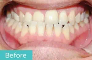 Patient's teeth before orthodontic treatment (case 5)