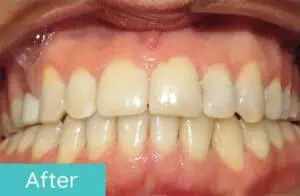 Patient's teeth after orthodontic treatment (case 5)